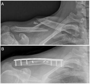 A) Radiografía preoperatoria de clavícula inclinada hacia arriba de 45° muestra un tipo de fractura Robinson 2B2 (desplazada, conminuta y segmentaria) en un jugador de rugby de 17 años. B) Radiografía postoperatoria que muestra consolidación ósea de la fractura de clavícula tres meses después de la fijación quirúrgica con una placa de bloqueo precontorneada y tres tornillos interfragmentarios.