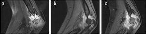 Adolescente, 14 años. Osteoartritis con absceso epifisario de cúbito. Grado 1. Se realizó biopsia sinovial y ósea abierta. El último balance articular fue limitado: flexión 90°, extensión -70° y pronosupinación normales. Posterior pérdida de seguimiento.