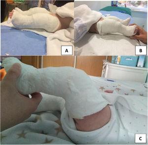 Imágenes de tratamiento conservador mediante yesos seriados en un mismo paciente. A y B: se muestra yeso en la rodilla derecha e izquierda al inicio del tratamiento. C: yeso a las tras 3 semanas.
