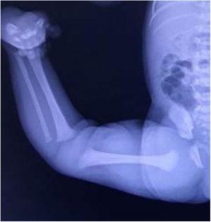 Radiografía simple de paciente con luxación congénita de rodilla, en el que se puede observar hiperextensión llamativa de la rodilla derecha.
