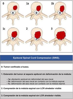 Epidural Spinal Cord Compression.