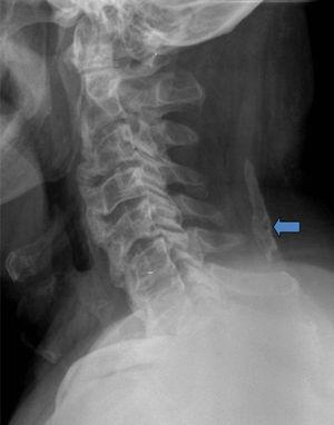 Radiografía lateral de columna cervical con osificación exuberante en los cuerpos vertebrales desde C2 a C7. Se aprecia otra gruesa calcificación en el ligamento nucal en partes blandas posteriores (flecha).