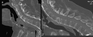 3D CAT images: (a) on admission and (b) after two months, when treatment with teriparatide was instituted.