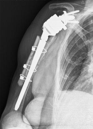 Radiographic follow-up at 6 months after surgery due to a third periprosthetic fracture after 3 different and successive falls in the same patient. A lateral cortical defect can be observed in the distal third of the humerus. A cortical allograft was not added in this area due to the risk of causing too much tension on the radial nerve.
