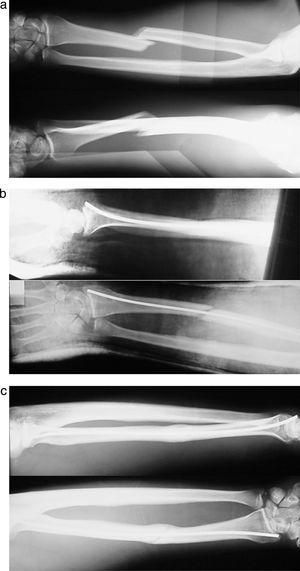 (a) Preoperative diaphyseal fracture X-ray of the radius. (b) Immediate postoperative results. (c) X-ray after 3 months. Bone consolidation.