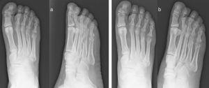 (a) Subcapital fracture of the fifth metatarsal associated with displaced diaphyseal metaphyseal fracture of the fourth metatarsal of the right foot. (b) Progress after four months.