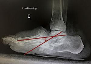 Alteration of Meary's line in the midfoot deformity.