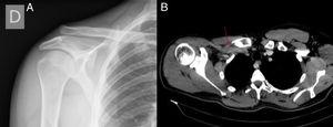 (A) Radiological study of the right shoulder where a Rockwood grade III acromioclavicular dislocation (complete rupture of the acromioclavicular and coraco-clavicular ligament. Coraco-clavicular distance 25–100%) can be seen. (B) Computerized axial tomography with contrast in which the partial thrombosis of the subclavian vein suffered by the patient is indicated.