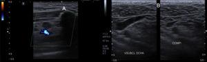 (A) Doppler ultrasound in which hypoechogenic images can be seen in the subclavian vein, suspecting deep vein thrombosis. (B) Doppler ultrasound 6 months following the trauma and treatment with anticoagulation in which there is no imaging evidence of thrombosis and a permeable, elastic subclavian vein can be seen.