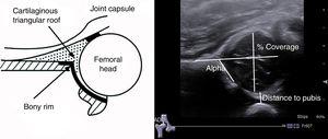 Ultrasound parameters studied: alpha angle, percentage of coverage of the femoral head, and distance to pubis.