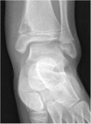 Standard radiography showing metaphyseal lytic lesion at distal tibia level.
