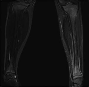 Extensive involvement of the left tibia observed after bone puncture in MRI. The total bone involvement is appreciated with the main lesion at distal metaphysic level and oedema of adjacent soft tissues.