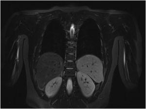 Silent active bone lesion (vertebra D8) in whole-body MRI.