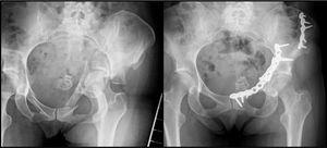 The images correspond to the patient in Fig. 1, a 51-year-old woman with a fracture of the 2 columns. Through an lateral access window, the fracture of the iliac fossa was reduced. Subsequently a Stoppa approach was created through which the remaining components of the fracture could be reduced and stabilised, including the quadrilateral plate. An anatomical quality reduction was achieved.