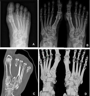 Diagnostic imaging on the right foot. A) Initial non-weight-bearing X-ray. B) Weight-bearing X-ray as an outpatient where both feet are included. C-D) CT image; axial cut and reconstruction where diastasis can be seen with respect to the healthy side.