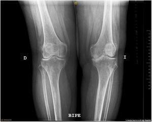 Preoperative X-ray image while standing.