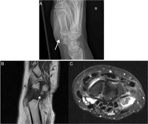 A) Simple X-ray image. Exophytic image with continuity with adjacent bone cortex with a broad base at the level of the pisiform. B-C) Magnetic resonance image of the carpus. Solitary osteochondroma pediculated in the pisiform, an exophytic lesion with corticomedular continuity in the proximal pole measuring 5 × 5 mm surrounded by synovial fluid with correct tendinous and ligament structures.