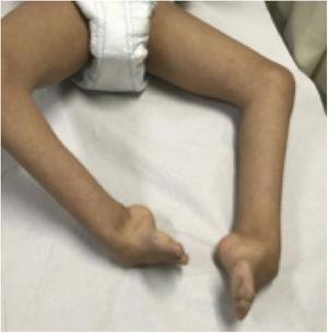 13-year-old patient with Cornelia de Lange syndrome and bilateral clubfeet.