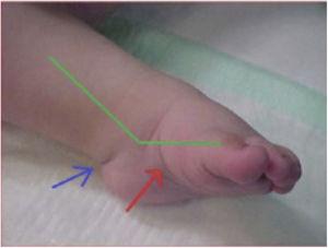 Clubfoot showing three of the signs of Pirani’s classification: medial crease (red arrow), posterior crease (blue arrow) and equinus component (green line).
