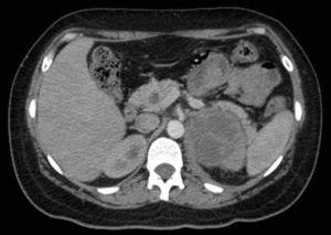 Tomografía abdominal con presencia de quiste renal IIF.