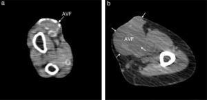 Computed tomographic scan showing calcification of the arteriovenous fistula (AVF) (a) and a non-calcified AVF (b).