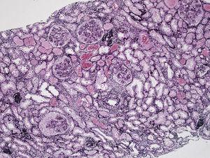 Renal biopsy. Methenamine-silver staining. Glomeruli are seen with increased cellularity, at an endocapillary level and with formation of extracapillary crescents.