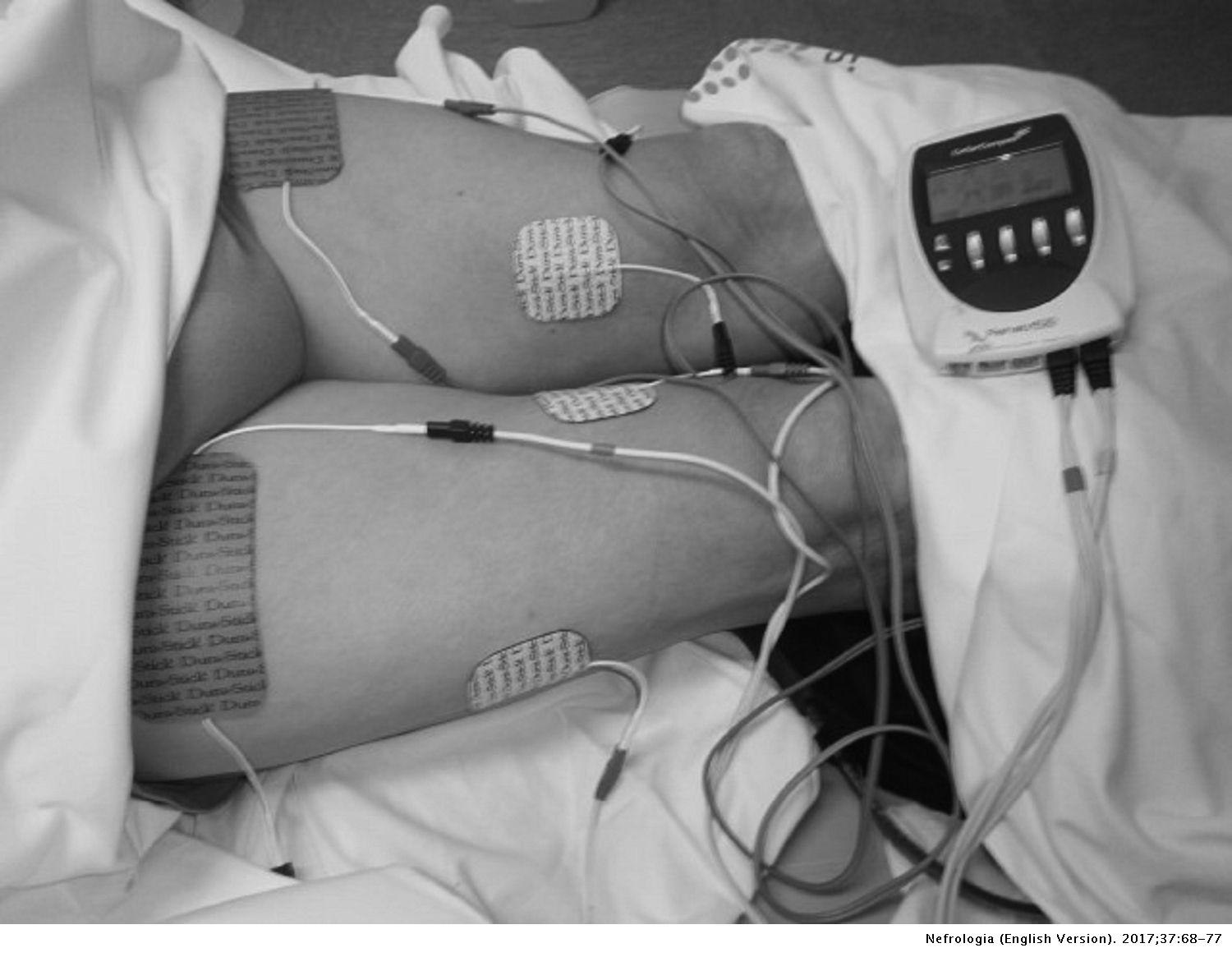 The effect of neuromuscular electrical stimulation on muscle strength,  functional capacity and body composition in haemodialysis patients