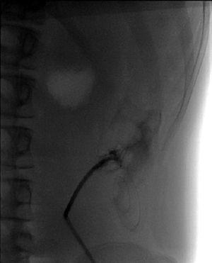 Fluoroscopic peritoneography with contrast outflow through upper orifices and tail obstruction.
