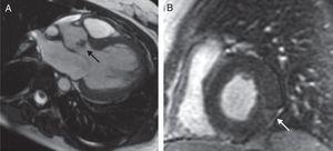 Cardiac MRI with contrast dye. (A) Fast imaging employing steady-state acquisition (FIESTA) sequence in left ventricular (LV) outflow tract, showing a vegetation on the aortic valve (arrow). (B) Short-axis delayed gadolinium-enhanced sequence of the LV, showing an image of subepicardial enhancement at the level of the inferolateral segment suggestive of a vasculitic process (arrow).
