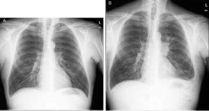 PA chest X-ray: (A) prior treatment with rituximab and (B) after treatment and diagnosis of lung carcinoma.