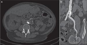 Computed tomographic angiography. (a) In the cross-section, an intraluminal calcified lesion was observed at the origin of the left common iliac artery. (b) In the multilane reconstruction, it is observed permeability without stenosis in the renal artery of the transplanted graft.