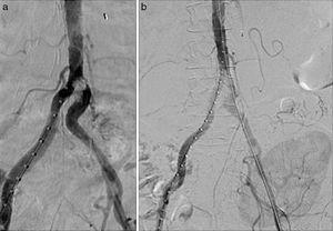 Intraoperative arteriography. (a) A calcified intraluminal lesion was observed at the origin of the left common iliac artery. (b) Post-implantation control of the coated stents without residual stenosis.