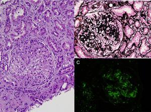 Glomerular mesangial and endocapillary hypercellularity (A), basement membrane duplication and crescent formation (B), and, mesangial and capillary C3 deposits by immunfluoresence (C) in renal biopsy (A, hematoxylin–eosin; B, periodic acid methenamin silver; C, anti-C3 FITC).