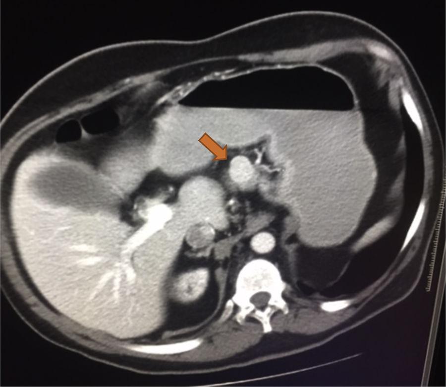 The Rubinstein-Taybi syndrome.  Archives of Disease in Childhood