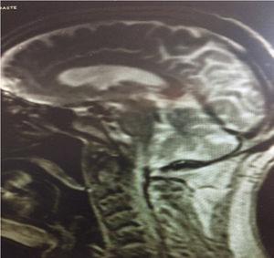 A brain RMN of a patient affected with GBS secondary to tacrolimus.