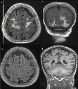 Flair sequence where hyperintensity of the white subcortical substance of frontal lobes (a) and occipital lobes (b) can be seen, with subsequent resolution after treatment and endovascular therapy (c, d).