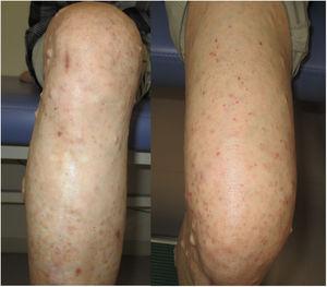 Subsidence of palpable purpura on the left leg after initiating enalapril.