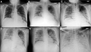 Chest X-ray, progression on days 1 (A), 2 (B), 3 (C), 6 (D), 9 (E) and 12 (F).