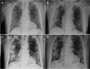 Chest X-ray showing the patient's radiological course during his first admission (A–B) and his second admission (C–D).