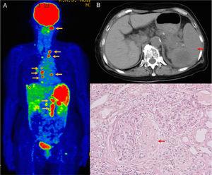 Findings of 18F-fluorodeoxyglucose-positron emission tomography/computed tomography (FDG-PET-CT), abdominal enhanced CT, and renal biopsy. (A) FDG-PET-CT shows FDG accumulation in the cervical, thoracic, and abdominal lymph nodes (yellow arrows) and spleen, indicating widespread lymphadenopathy and splenomegaly. (B) Abdominal enhanced CT shows splenomegaly (red arrow) with a low-density area. (C) Renal biopsy specimen reveals crescentic glomerulonephritis with fibrocellular crescent (arrow, Periodic acid-Schiff stain).