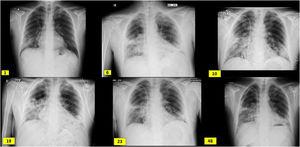 Radiological evolution since admission (day 1), boluses of methylprednisolone (day 6), kidney biopsy (day 10), initiation of tocilizumab (day 19), initiation of rituximab (day 23) and hospital discharge (day 48). It shows subpleural peripheral reticular thickening of the middle fields, right basal field and lingula and interstitial alveolar opacities in the middle and lower fields of the right lung and lower fields of the left lung.