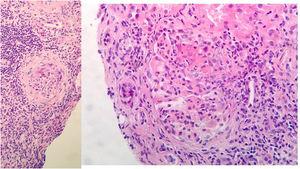 Renal biopsy: 11 glomeruli, 3 were globally sclerosed. Five with minor congestive changes and 3 with extracapillary proliferation and cell crescent formation. Tubulointerstitial compartment with chronic and acute inflammation, 30% tubular atrophy, tubular thyroidization, and 30% interstitial fibrosis. No changes in medium size vessels, or thickening of the media layer of the arteries. No congophilic deposits. Direct immunofluorescence with slight granular mesangial deposit of C3+, without deposits of IgG, IgM, IgA or restriction of light chains.