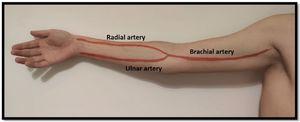 Arterial anatomy of the upper limb.