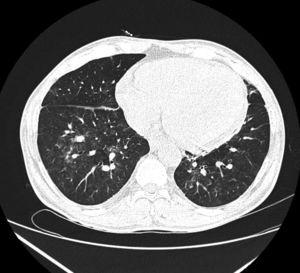 Computerized tomography of chest- lung window (axial section) showing patchy consolidation and ground glass opacities in bilateral lower lobes suggestive of viral pneumonia.