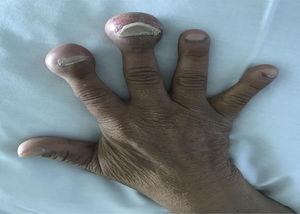 Photo of the patient's hand, with swelling in the distal phalanges of the fingers.