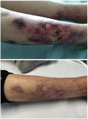 Lesions on the right lower limb during hospital admission (top) and five months after treatment with thiosulfate and expanded daily haemodialysis (bottom).