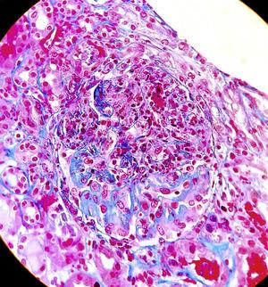 Optical microscopy (20x). Haematoxylin-eosin staining shows glomerulus with epithelioid crescent collapsing the glomerular tuft.