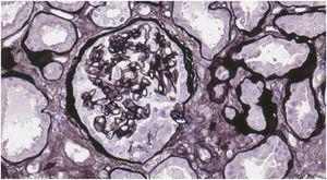 Glomerulus with circumferential epithelial crescent. Jones Silver ×40.