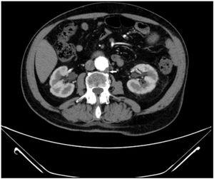 Aortic thrombosis. Axial computed tomography of the abdomen following administration of arterial-phase intravenous contrast, showing a 32×27-mm dilation of the infrarenal aorta, with a small 6-mm-thick intramural thrombus on the posterior left aspect (arrow).