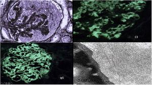 Upper left: glomerulus with circumferential epithelial crescent with disruption of the basement membrane and positive staining of the basals and mesangium. Jones silver ×40. Upper right: mesangial granular and pseudolinear 2+ de C3 positivity. IFD C3 × 40. Lower left: linear/pseudolinear 3+ parietal IgG positivity. IFD IgG × 40. Lower right: by EM, dense, banded and continuous deposits, linear in appearance, are observed along the lamina densa of the glomerular basement membranes and in the mesangium constituted by randomly arranged fibrils, whose mean thickness was 18.41 nm.